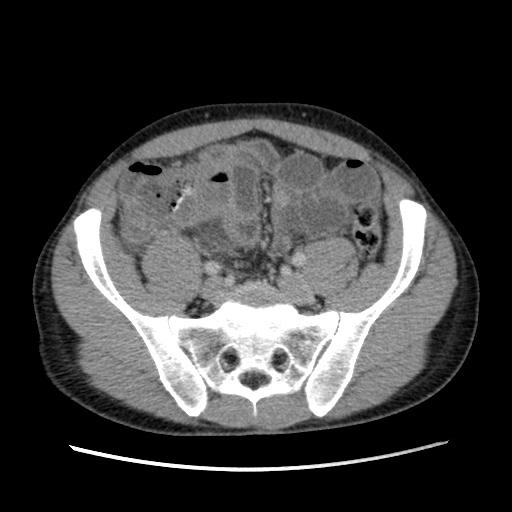File:Appendicitis complicated by post-operative collection (Radiopaedia 35595-37114 A 63).jpg