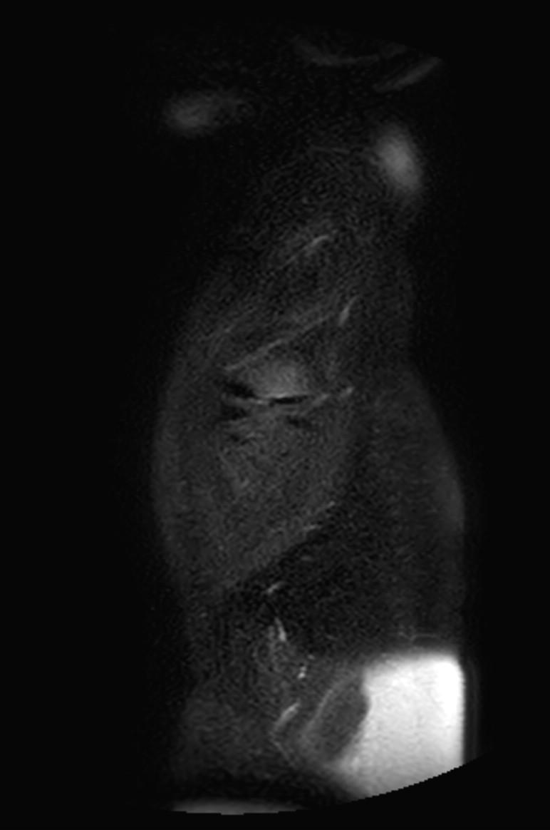 Appendicitis in gravida (MRI) (Radiopaedia 89433-106395 Sagittal T2 SPAIR 59).jpg