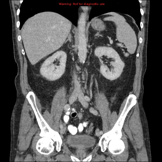 File:Appendicitis mass in inguinal hernia (Radiopaedia 26858-27029 B 42).jpg