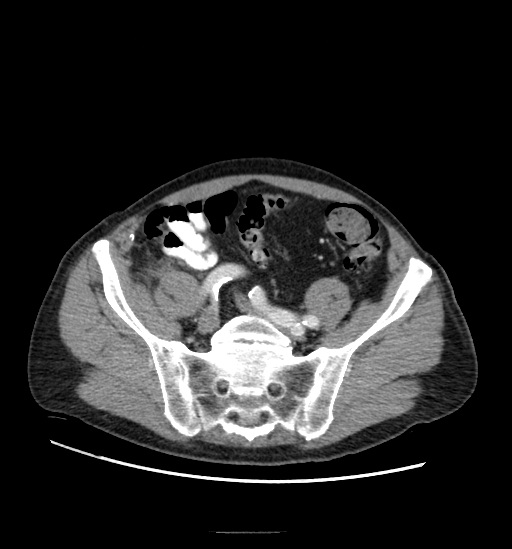 Appendicitis with localized perforation and abscess formation (Radiopaedia 49035-54130 A 67).jpg