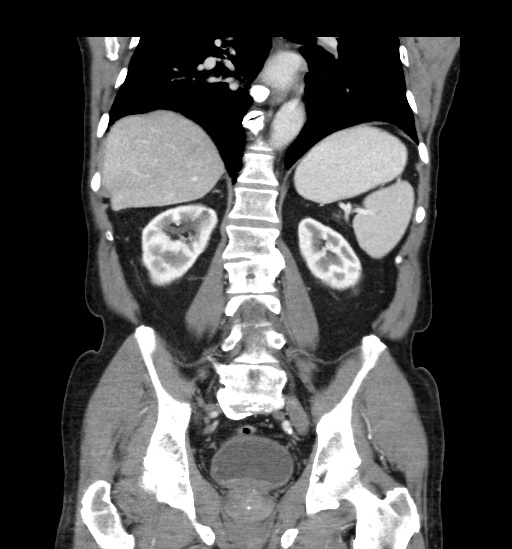 File:Appendicitis with localized perforation and abscess formation (Radiopaedia 49035-54130 B 33).jpg
