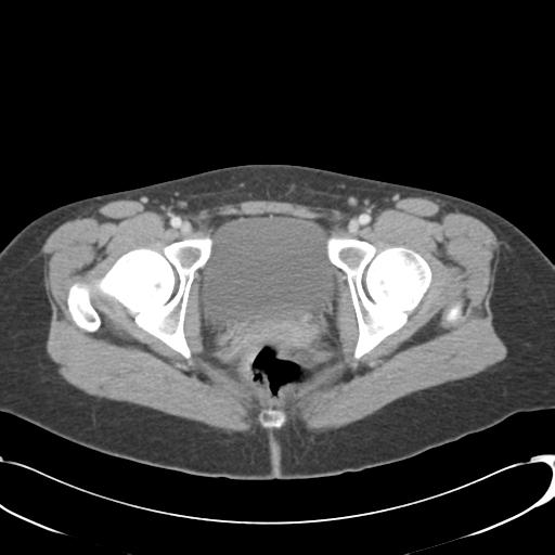 Appendicitis with minimal stranding but appendicolith (Radiopaedia 29035-29397 A 81).jpg