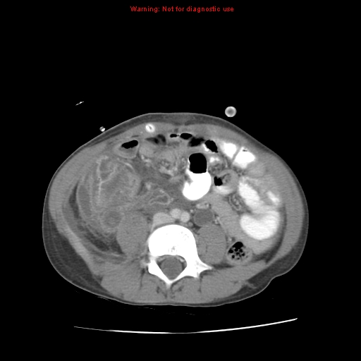 File:Appendicitis with phlegmon (Radiopaedia 9358-10046 A 44).jpg
