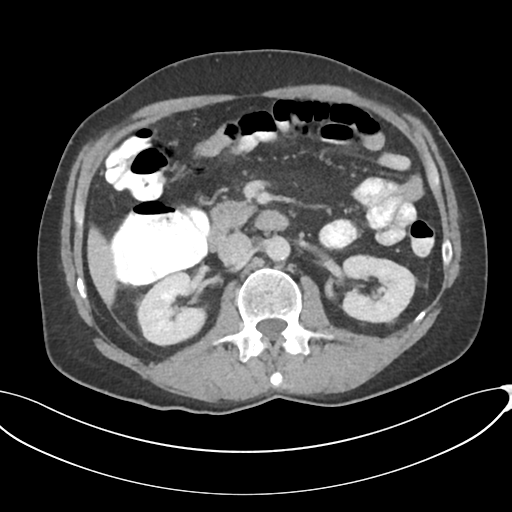 Appendicitis with thickening of the terminal ileum (Radiopaedia 42432-45550 A 41).png