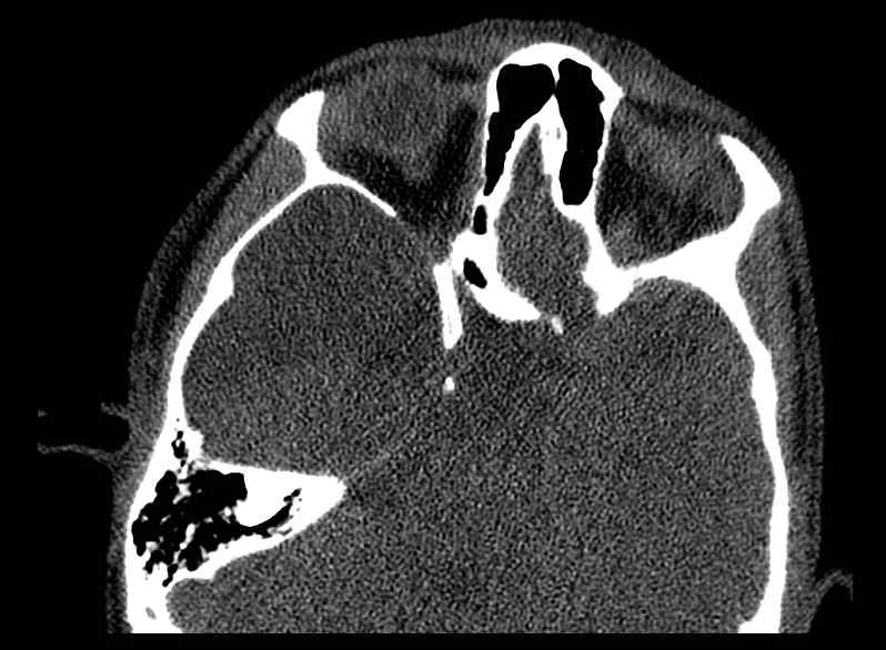 Arachnoid cyst- extremely large (Radiopaedia 68741-78450 Axial bone window 30).jpg
