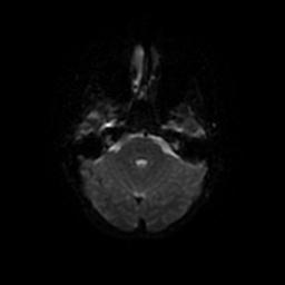 Arachnoid cyst - middle cranial fossa (Radiopaedia 67671-77088 Axial DWI 34).jpg