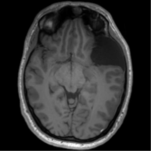 File:Arachnoid cyst with subdural hematoma (Radiopaedia 85892-101743 Axial T1 41).png
