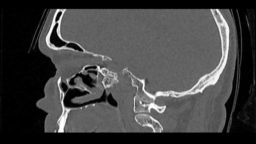 Arcuate foramen (Radiopaedia 89833-106944 Sagittal bone window 84).jpg