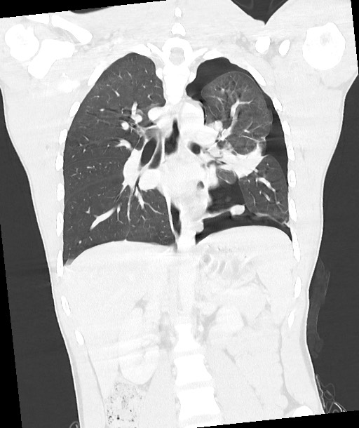 Arrow injury to the chest (Radiopaedia 85367-100975 Coronal lung window 82).jpg