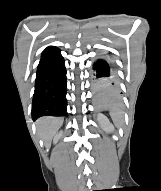 Arrow injury to the chest (Radiopaedia 85367-100975 F 106).jpg