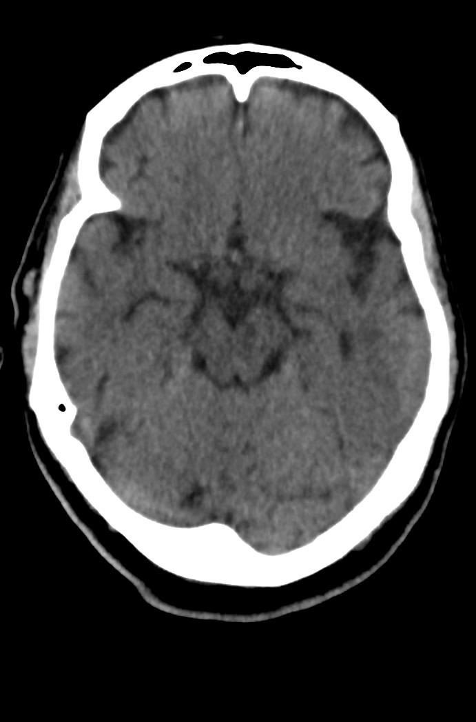 Artery of Percheron infarction (Radiopaedia 80613-94202 Axial non-contrast 76).jpg