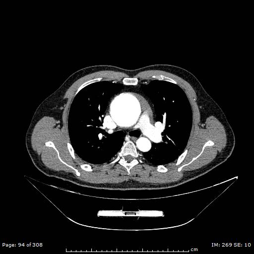 Ascending aortic aneurysm (Radiopaedia 50086-55404 A 25).jpg