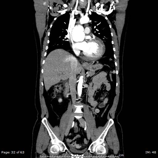 Ascending aortic aneurysm (Radiopaedia 50086-55404 B 32).jpg