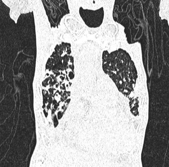 Aspergilloma- with Monod sign (Radiopaedia 44737-48532 Coronal lung window 155).jpg