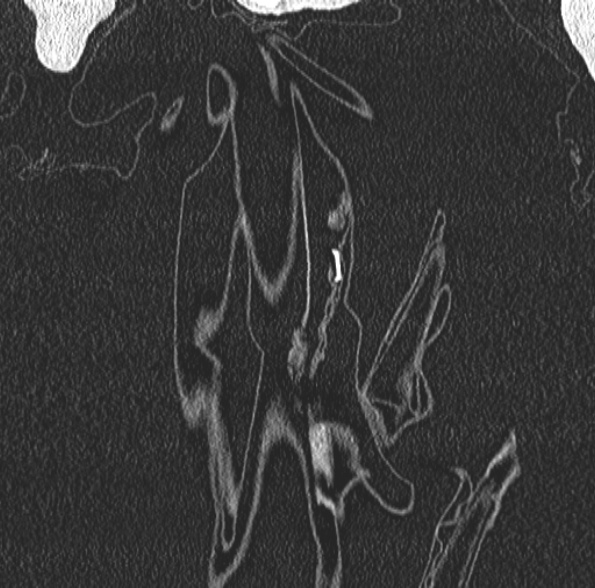 Aspergilloma- with Monod sign (Radiopaedia 44737-48532 Coronal lung window 72).jpg