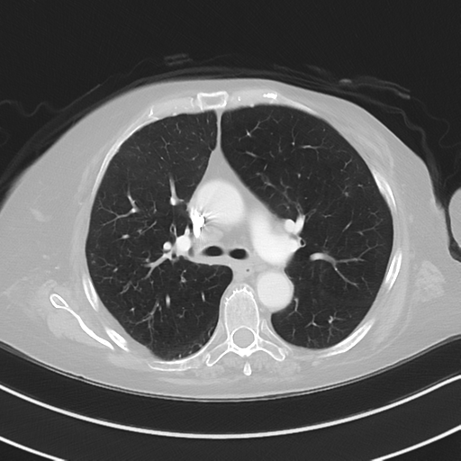 Aspiration bronchiolitis (Radiopaedia 53464-59463 Axial lung window 22).png