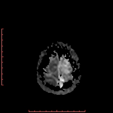 File:Astroblastoma (Radiopaedia 74287-85162 Axial ADC 66).jpg