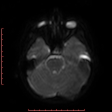 Astroblastoma (Radiopaedia 74287-85162 Axial DWI 26).jpg