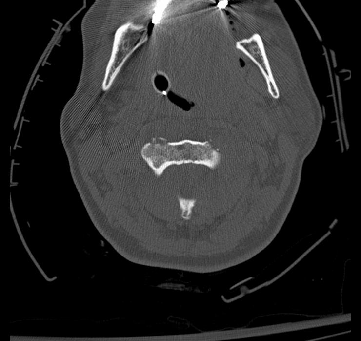 Atlanto-axial subluxation-dislocation (Radiopaedia 29659-30185 Axial bone window 38).jpg