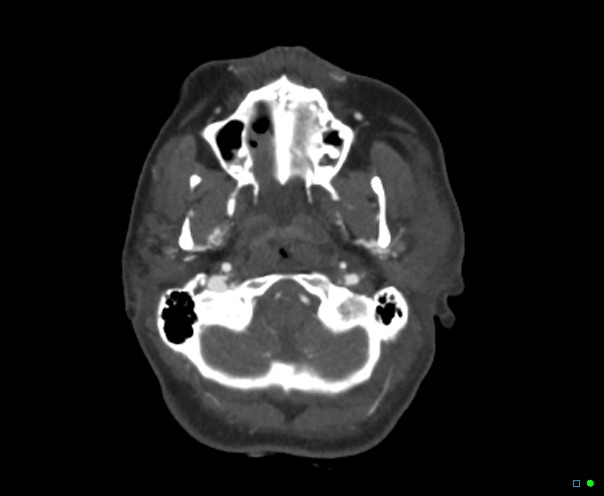 Atlanto-occipital dissociation - Traynelis type 1 (Radiopaedia 87570-103949 A 56).jpg