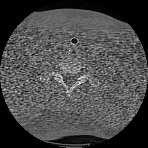 Atlanto-occipital dissociation injury (Radiopaedia 29274-29698 Axial bone window 66).png