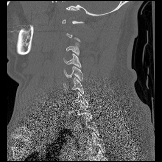 Atlanto-occipital dissociation injury (Radiopaedia 29274-29698 Sagittal bone window 41).png