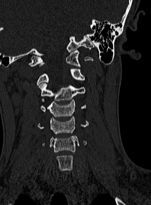 Atlantoaxial subluxation (Radiopaedia 44681-48450 Coronal bone window 55).jpg