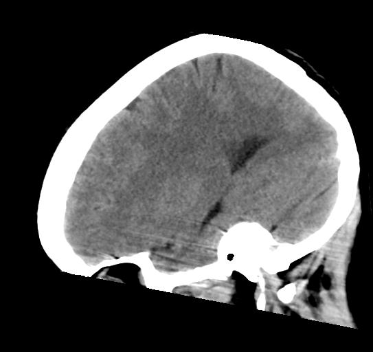 File:Atretic encephalocoele with inferior vermis hypoplasia (Radiopaedia 30443-31107 C 21).jpg