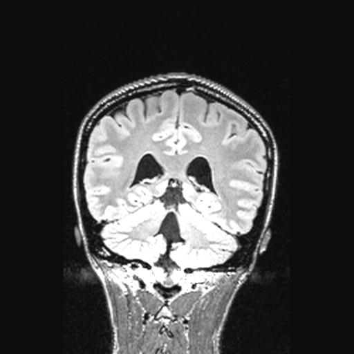 Atretic encephalocoele with inferior vermis hypoplasia (Radiopaedia 30443-31108 Coronal FLAIR 68).jpg