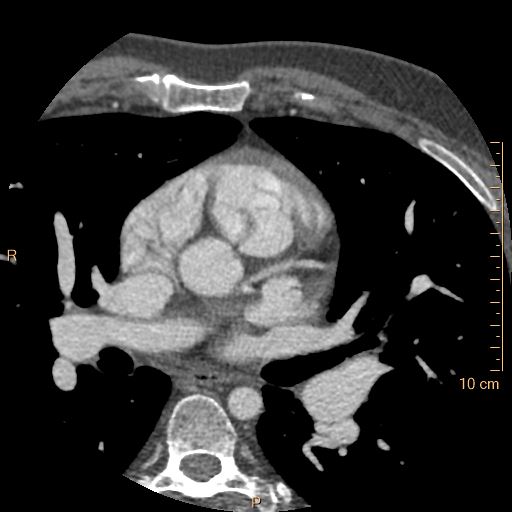 Atrial septal defect (upper sinus venosus type) with partial anomalous pulmonary venous return into superior vena cava (Radiopaedia 73228-83961 A 91).jpg