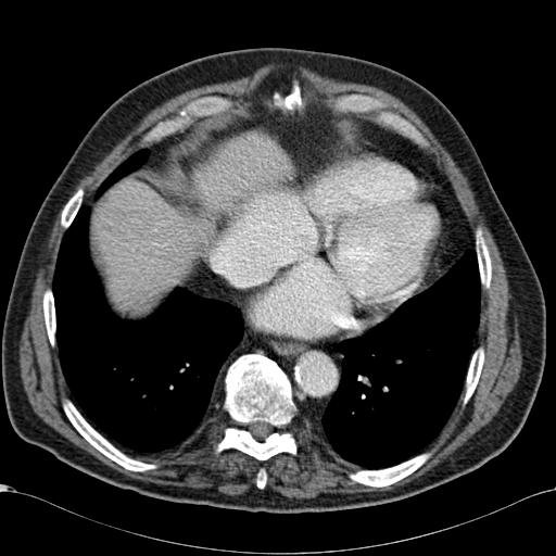 Atypical hepatocellular carcinoma (Radiopaedia 41744-44698 B 6).jpg