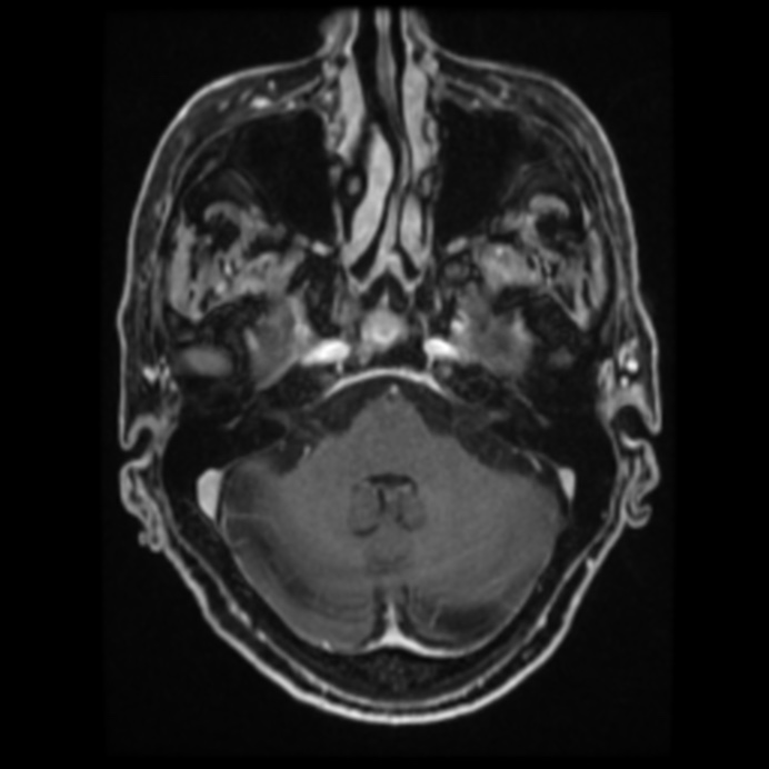 Atypical meningioma (Radiopaedia 45535-49629 Axial T1 C+ 24).jpg