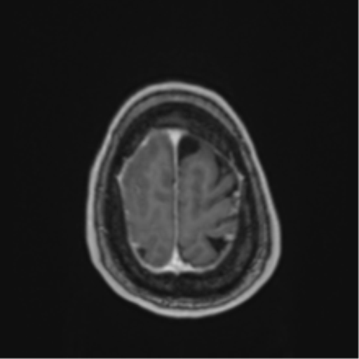 Atypical meningioma (WHO Grade II) (Radiopaedia 54742-60979 Axial T1 C+ 60).png