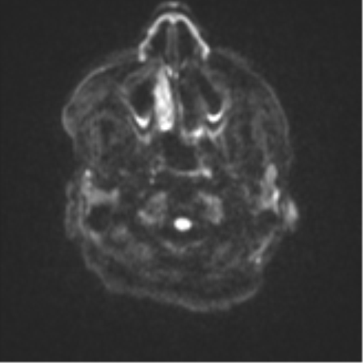 Atypical meningioma (WHO Grade II) (Radiopaedia 54742-60981 Axial DWI 29).png