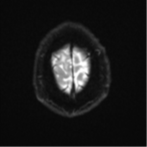Atypical meningioma (WHO grade II) with brain invasion (Radiopaedia 57767-64729 Axial DWI 28).png