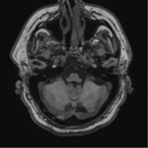 File:Atypical meningioma (WHO grade II) with brain invasion (Radiopaedia 57767-64729 Axial T1 9).png