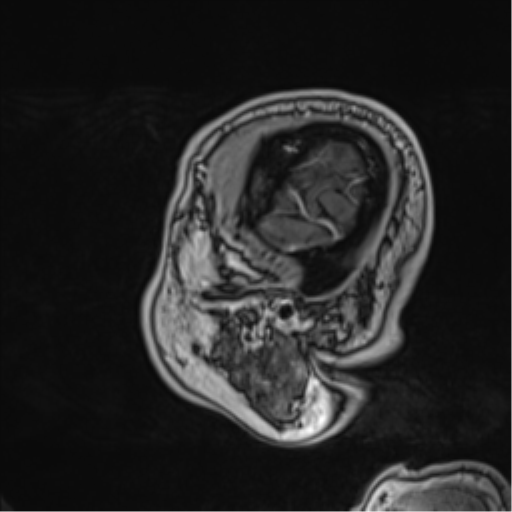 Atypical meningioma (WHO grade II) with brain invasion (Radiopaedia 57767-64729 Sagittal T1 C+ 13).png