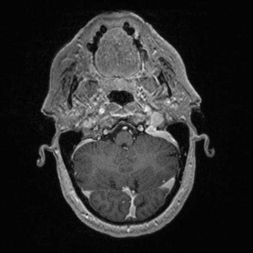 Atypical meningioma (grade II) - en plaque (Radiopaedia 29633-30147 Axial T1 C+ 38).jpg