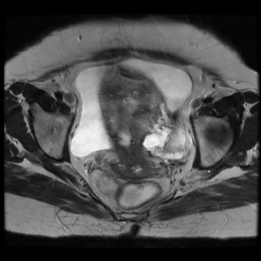 File:Atypical retroperitoneal lymphocoeles with large leiomyoma of uterus (Radiopaedia 32084-33027 Axial T2 23).jpg