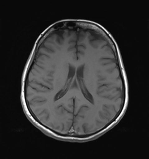 File:Autoimmune limbic encephalitis (Radiopaedia 30363-31005 Axial T1 20).jpg