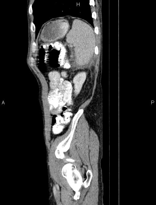 Autoimmune pancreatitis (Radiopaedia 84925-100431 E 83).jpg