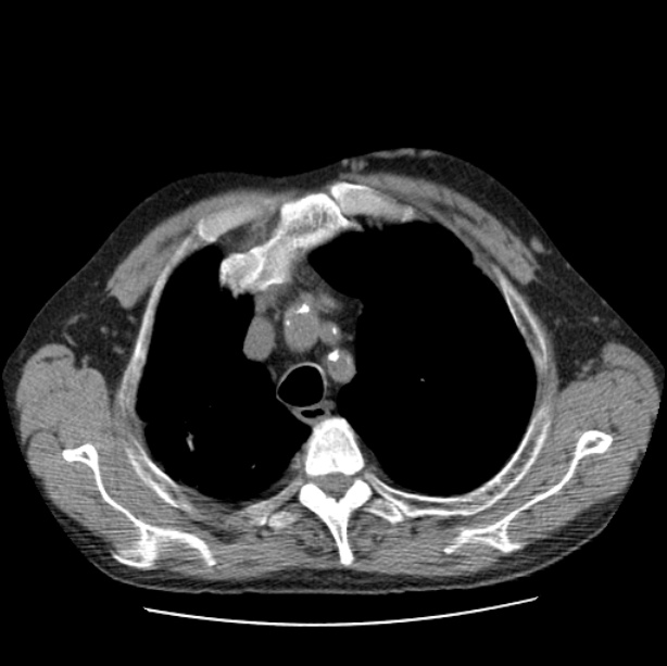 Autosomal dominant polycystic kidney disease (Radiopaedia 27851-28094 Axial non-contrast 12).jpg