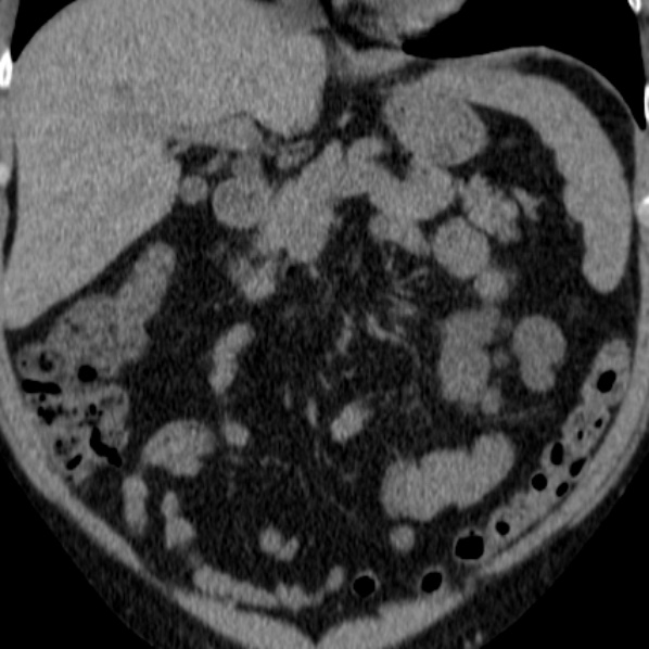 File:Autosomal dominant polycystic kidney disease (Radiopaedia 36539-38101 Coronal non-contrast 8).jpg