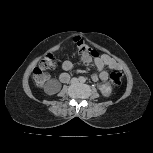 File:Autosomal dominant polycystic kidney disease (Radiopaedia 38189-40194 Axial C+ delayed 30).jpg