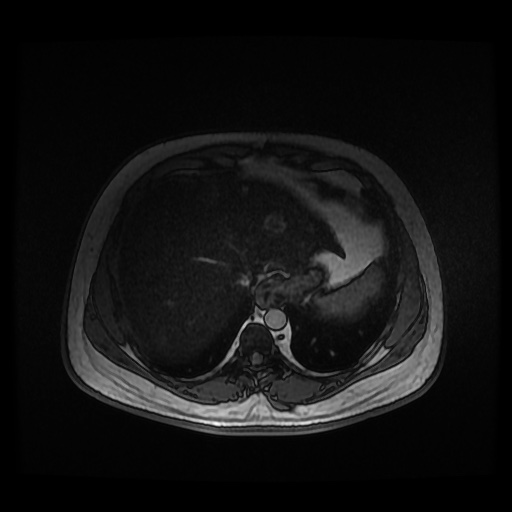 Autosomal dominant polycystic kidney disease (Radiopaedia 50259-55611 Axial 2D Dual Echo 17).jpg