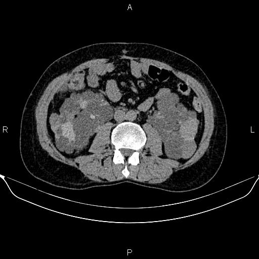 Autosomal dominant polycystic kidney disease (Radiopaedia 87830-104287 Axial non-contrast 29).jpg