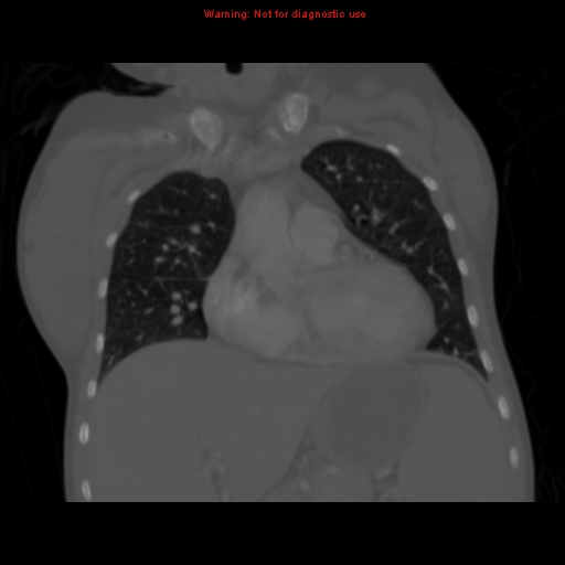 File:Avascular necrosis in sickle cell disease (Radiopaedia 17448-17152 Coronal bone window 45).jpg