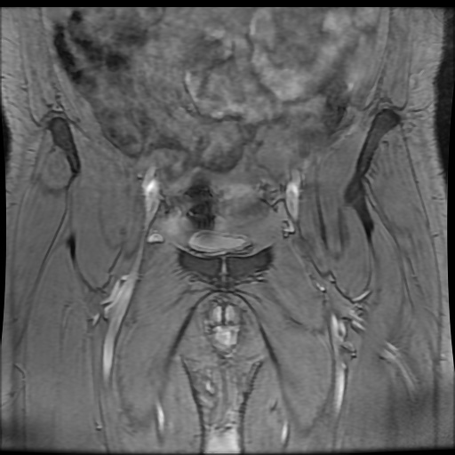Avascular necrosis of the hip (Radiopaedia 61503-69465 F 12).jpg