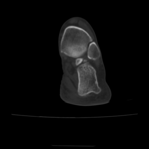 Avulsion fracture of the dorsal cuboid bone (Radiopaedia 51586-57377 Axial bone window 1).jpg