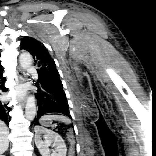 File:Axillary arterial pseudoaneurysm (Radiopaedia 24925-25195 B 15).jpg